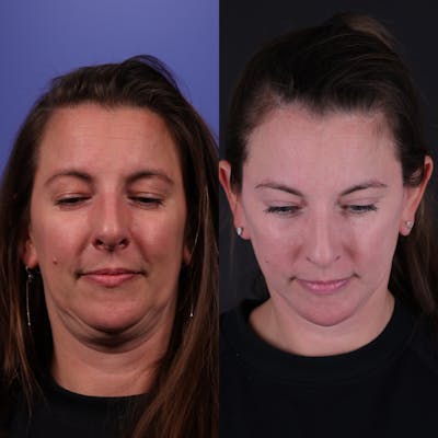 Face & Neck Lift Before & After Gallery - Patient 139584 - Image 6