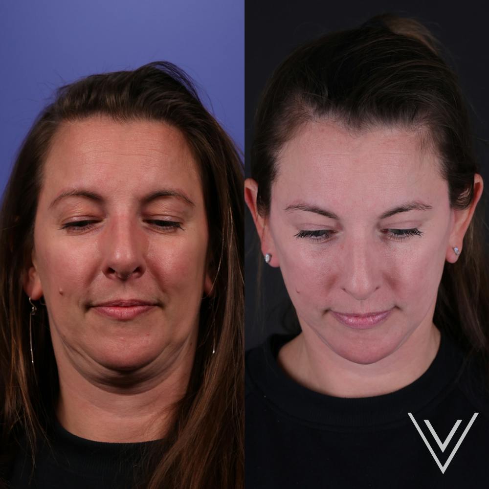 Face & Neck Lift Before & After Gallery - Patient 139584 - Image 6