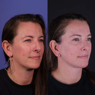 Face & Neck Lift Before & After Gallery - Patient 139584 - Image 1