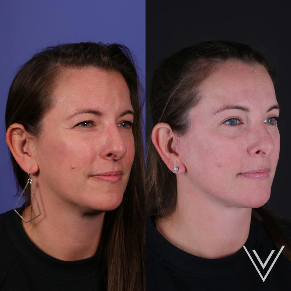 Face & Neck Lift Before & After Gallery - Patient 139584 - Image 1