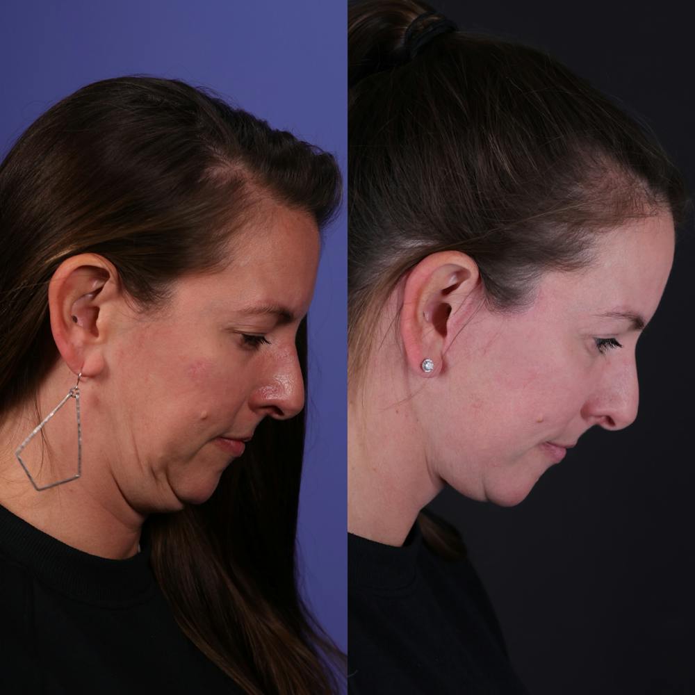 Face & Neck Lift Before & After Gallery - Patient 139584 - Image 3