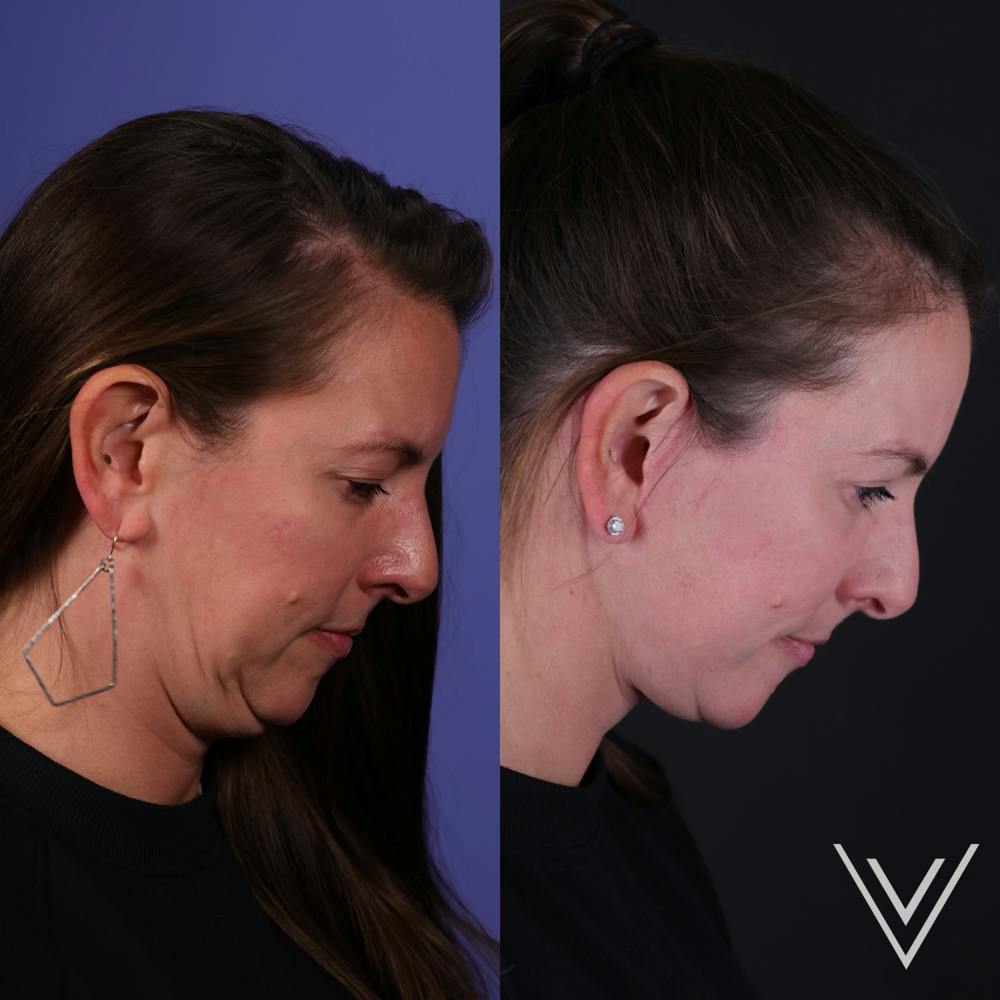 Face & Neck Lift Before & After Gallery - Patient 139584 - Image 3