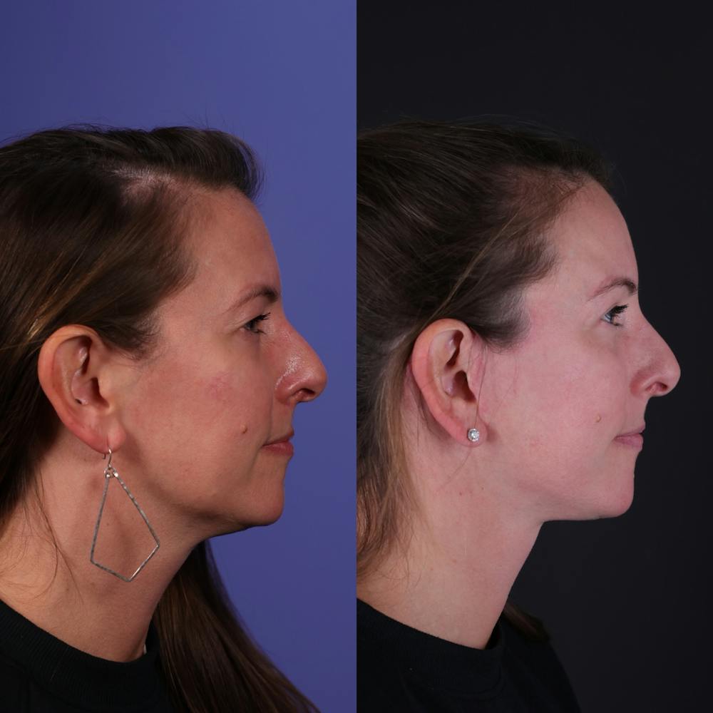 Face & Neck Lift Before & After Gallery - Patient 139584 - Image 2