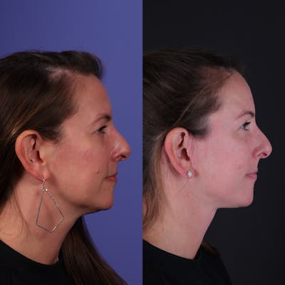 Face & Neck Lift Before & After Gallery - Patient 139584 - Image 2