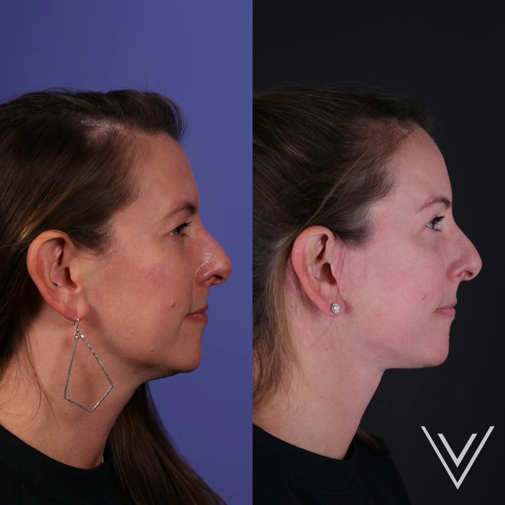 Face & Neck Lift Before & After Gallery - Patient 139584 - Image 2