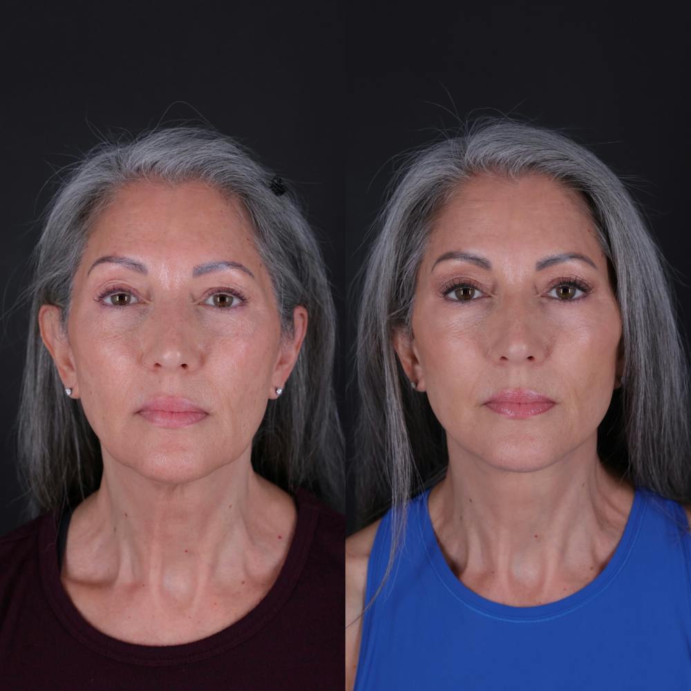 Face & Neck Lift Before & After Gallery - Patient 349581 - Image 4