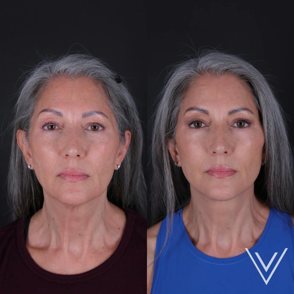 Face & Neck Lift Before & After Gallery - Patient 349581 - Image 4