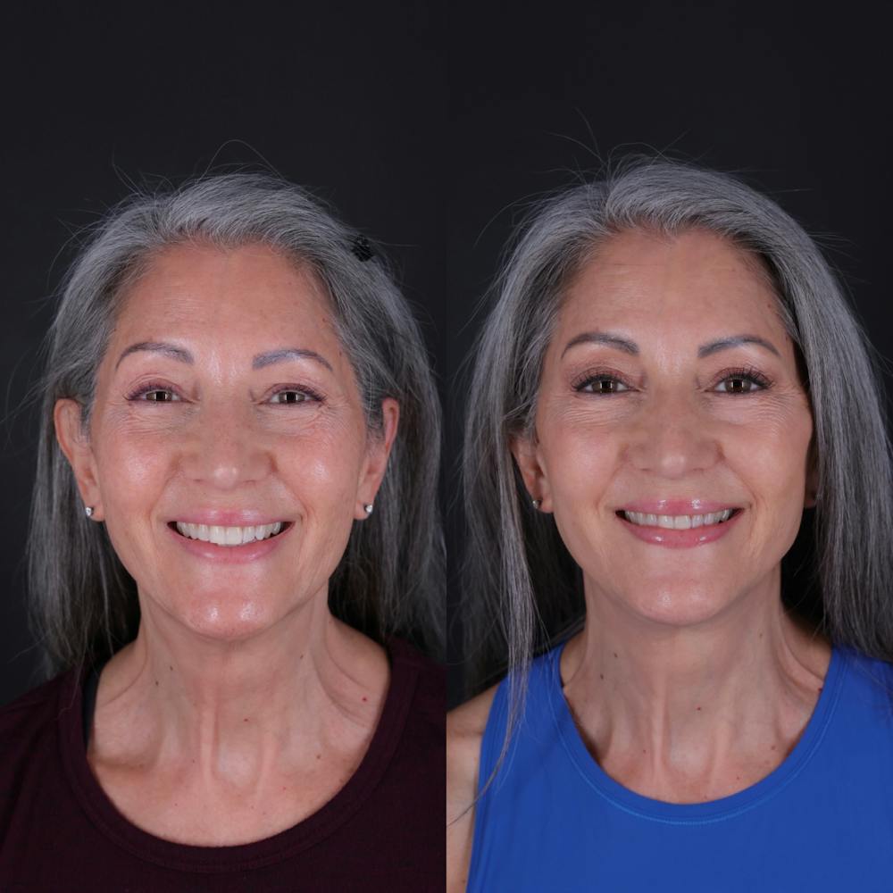 Face & Neck Lift Before & After Gallery - Patient 349581 - Image 5