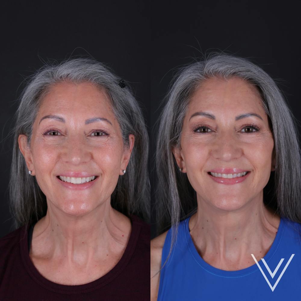 Face & Neck Lift Before & After Gallery - Patient 349581 - Image 5