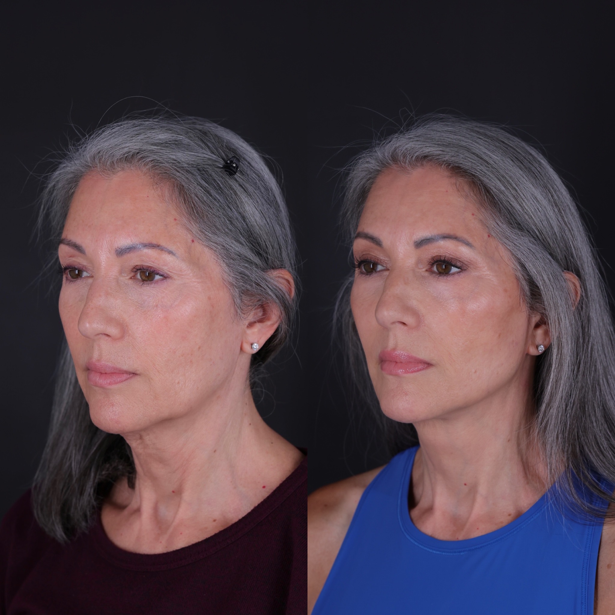 Patient 349581 | Facelift Gallery | Vila Facial Plastic Surgery