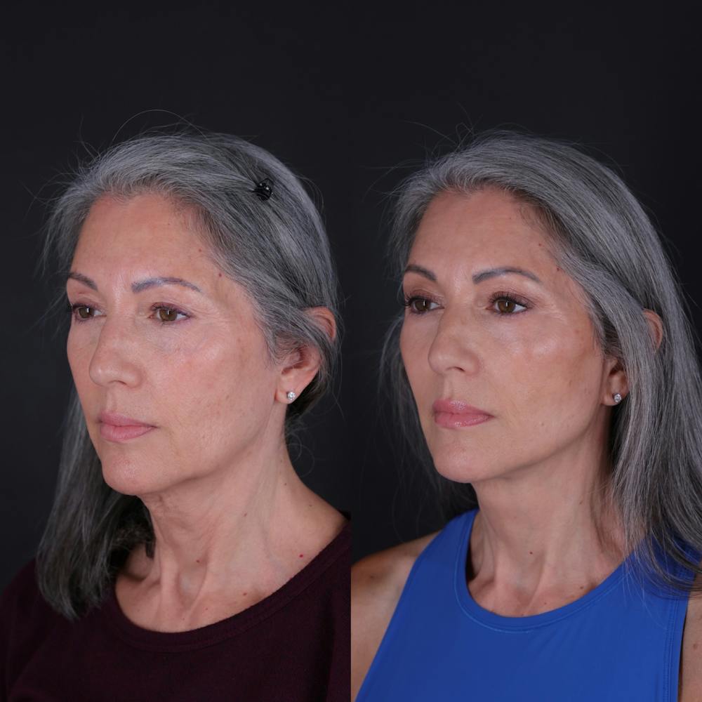 Face & Neck Lift Before & After Gallery - Patient 349581 - Image 1