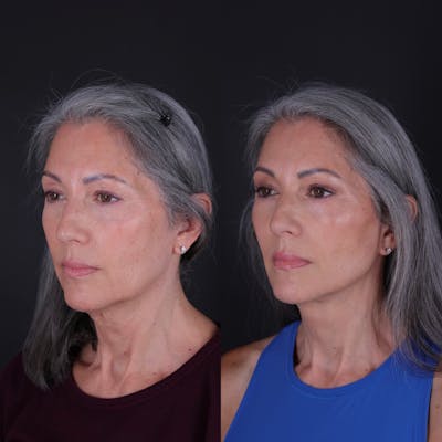 Face & Neck Lift Before & After Gallery - Patient 349581 - Image 1