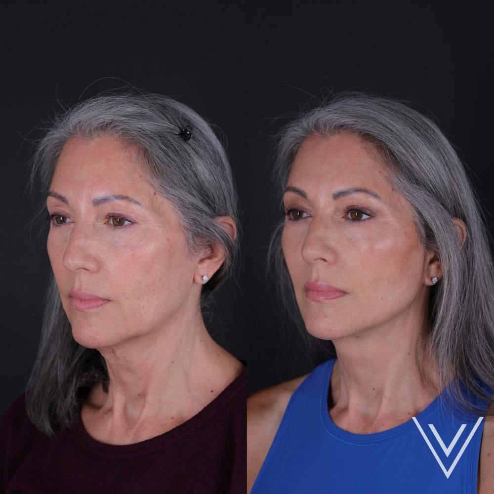 Face & Neck Lift Before & After Gallery - Patient 349581 - Image 1
