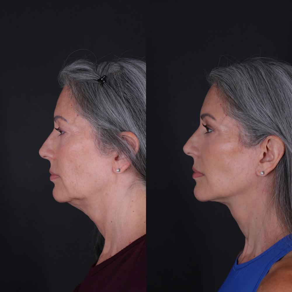 Face & Neck Lift Before & After Gallery - Patient 349581 - Image 2