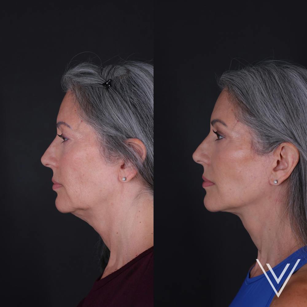 Face & Neck Lift Before & After Gallery - Patient 349581 - Image 2