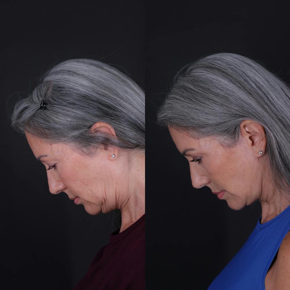 Face & Neck Lift Before & After Gallery - Patient 349581 - Image 3