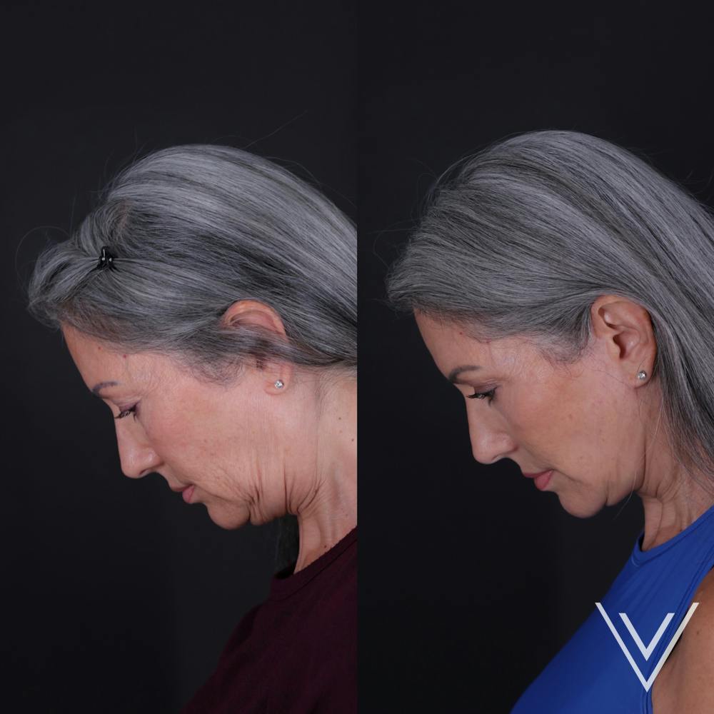 Face & Neck Lift Before & After Gallery - Patient 349581 - Image 3