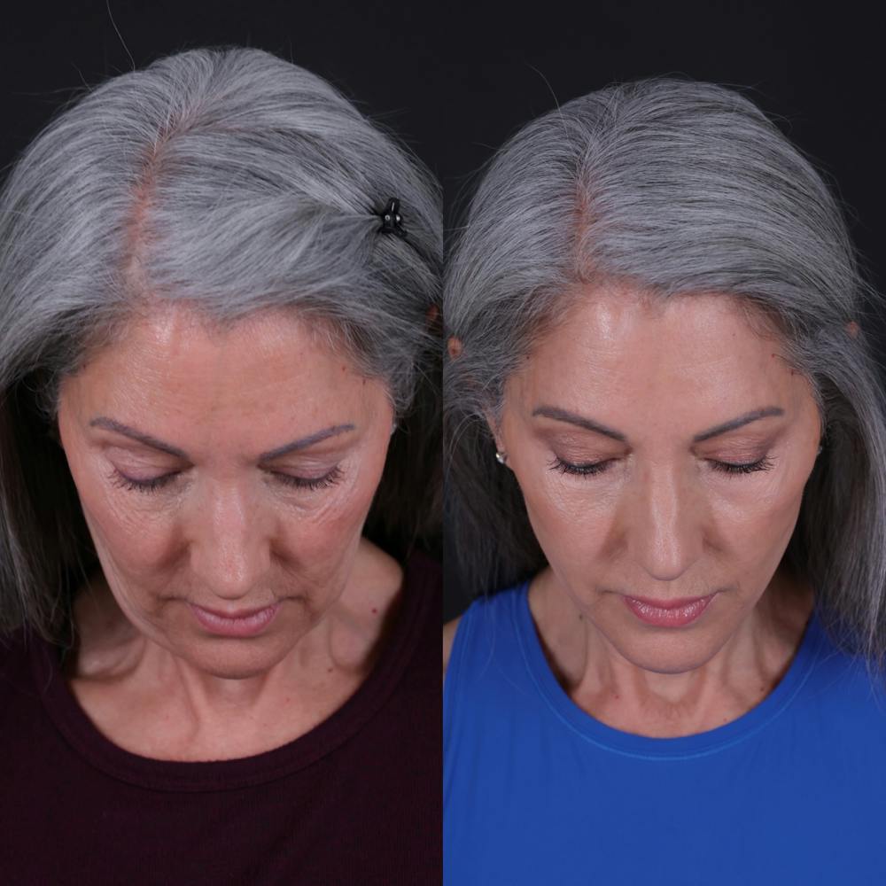 Face & Neck Lift Before & After Gallery - Patient 349581 - Image 6