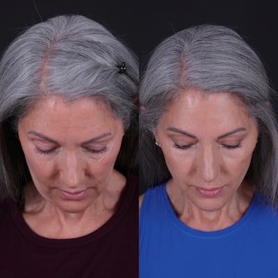Face & Neck Lift Before & After Gallery - Patient 349581 - Image 6
