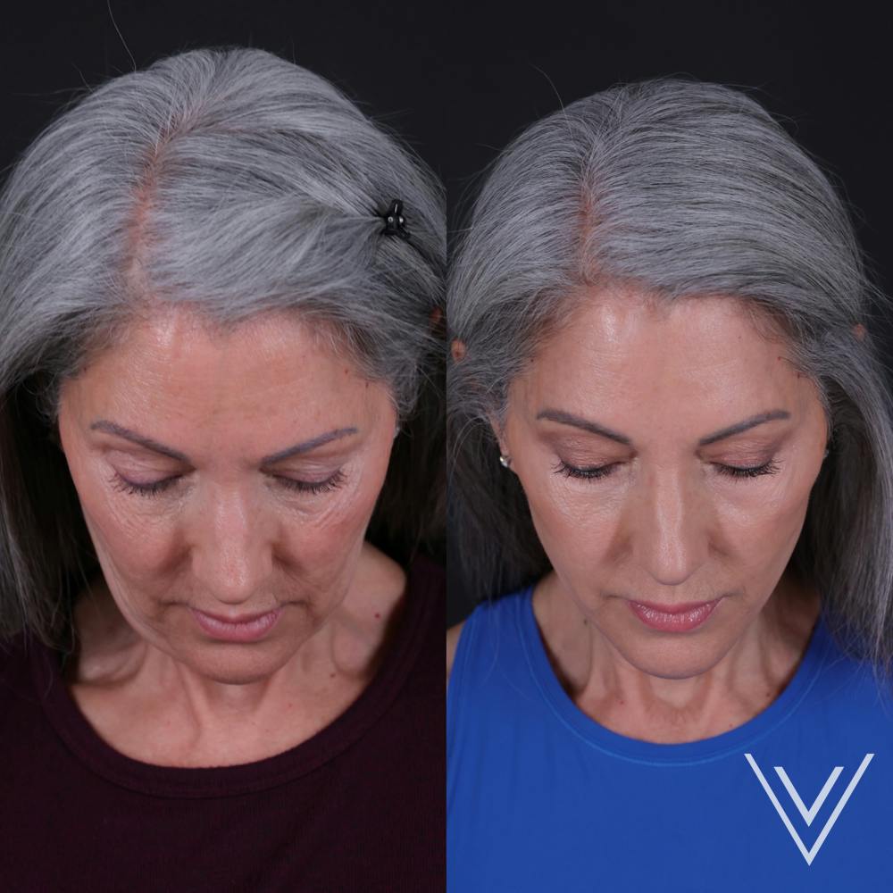 Face & Neck Lift Before & After Gallery - Patient 349581 - Image 6