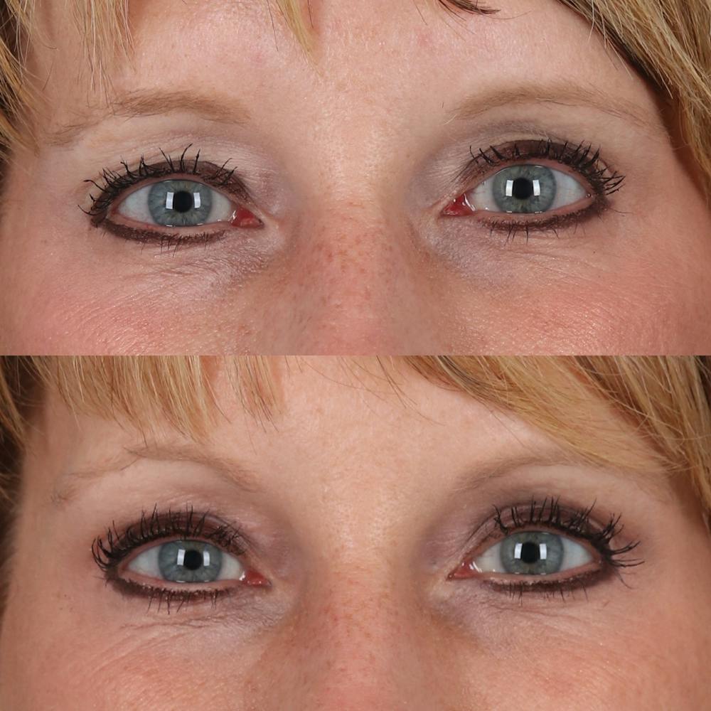 Browlift Before & After Gallery - Patient 329858 - Image 1