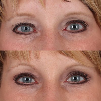 Browlift Before & After Gallery - Patient 329858 - Image 1