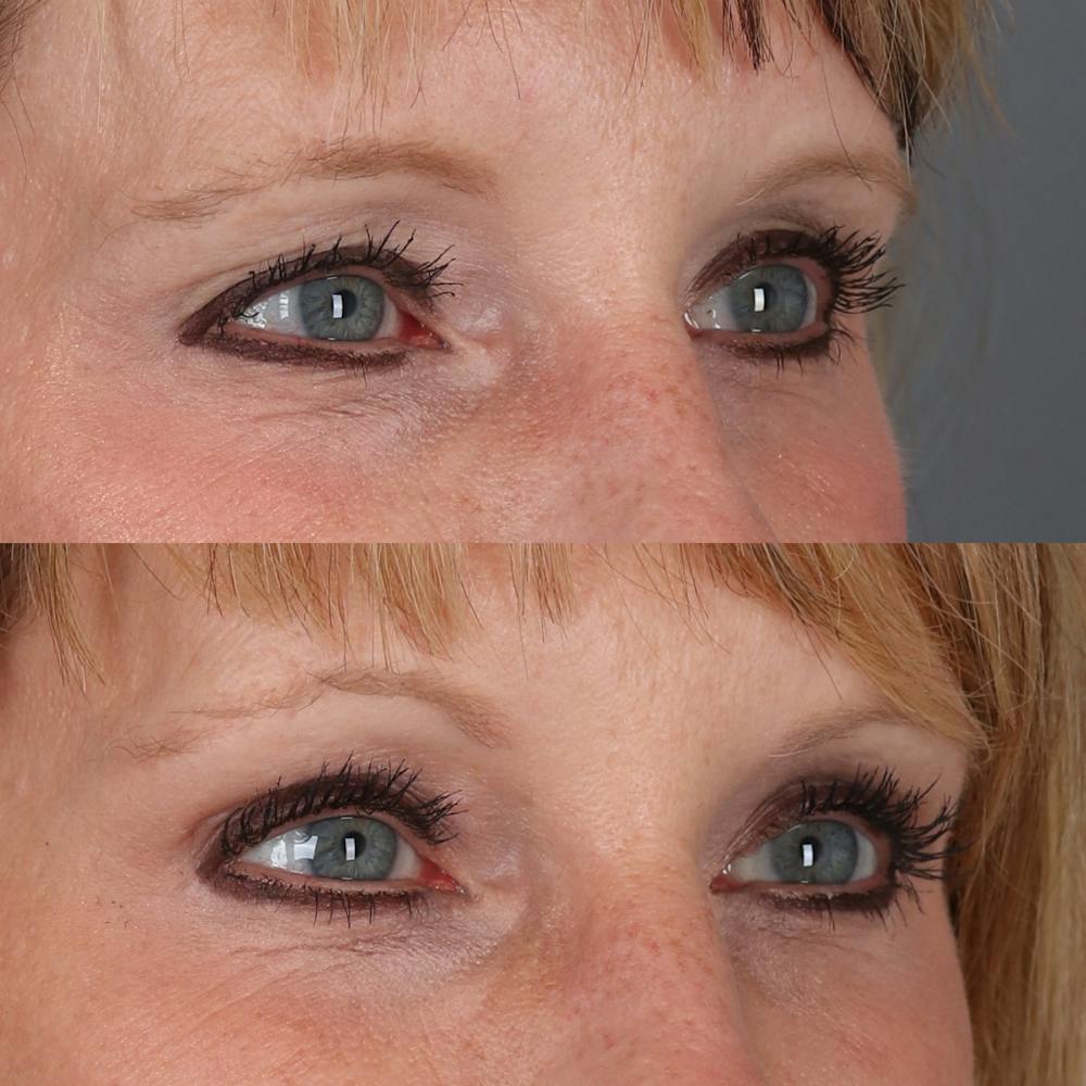 Browlift Before & After Gallery - Patient 329858 - Image 2