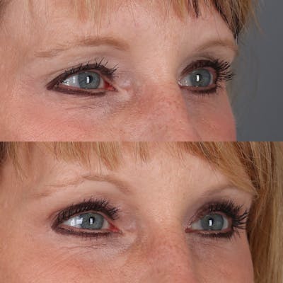 Browlift Before & After Gallery - Patient 329858 - Image 2