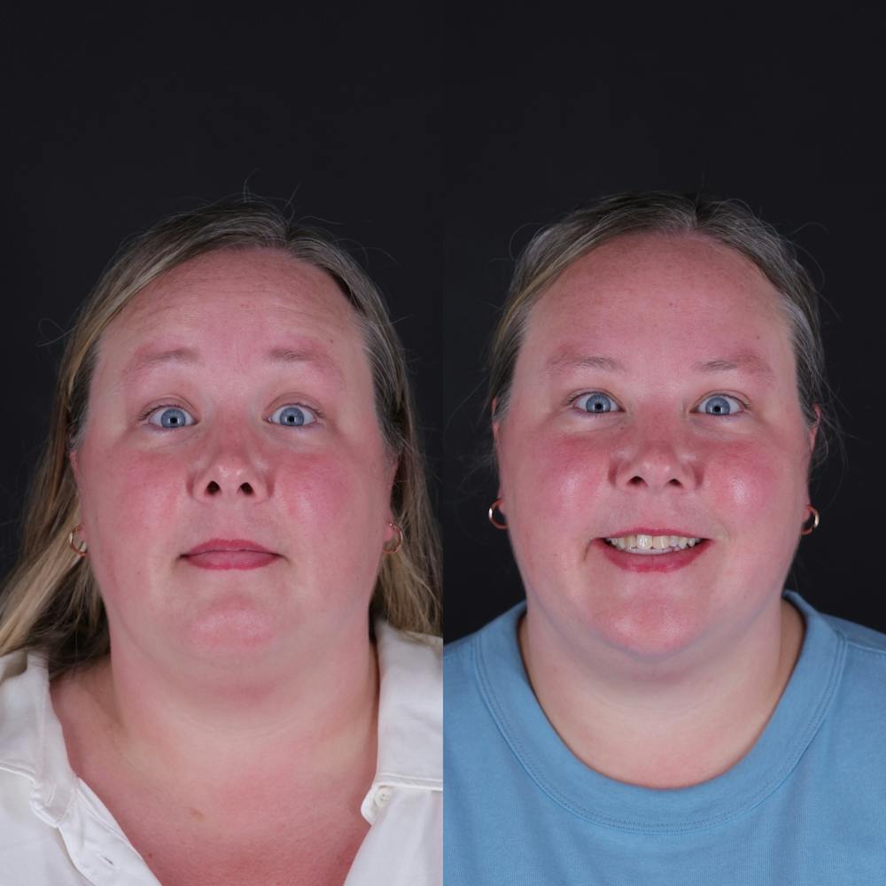 Botox Before & After Gallery - Patient 329948 - Image 2