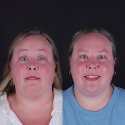 Botox Before & After Gallery - Patient 329948 - Image 2