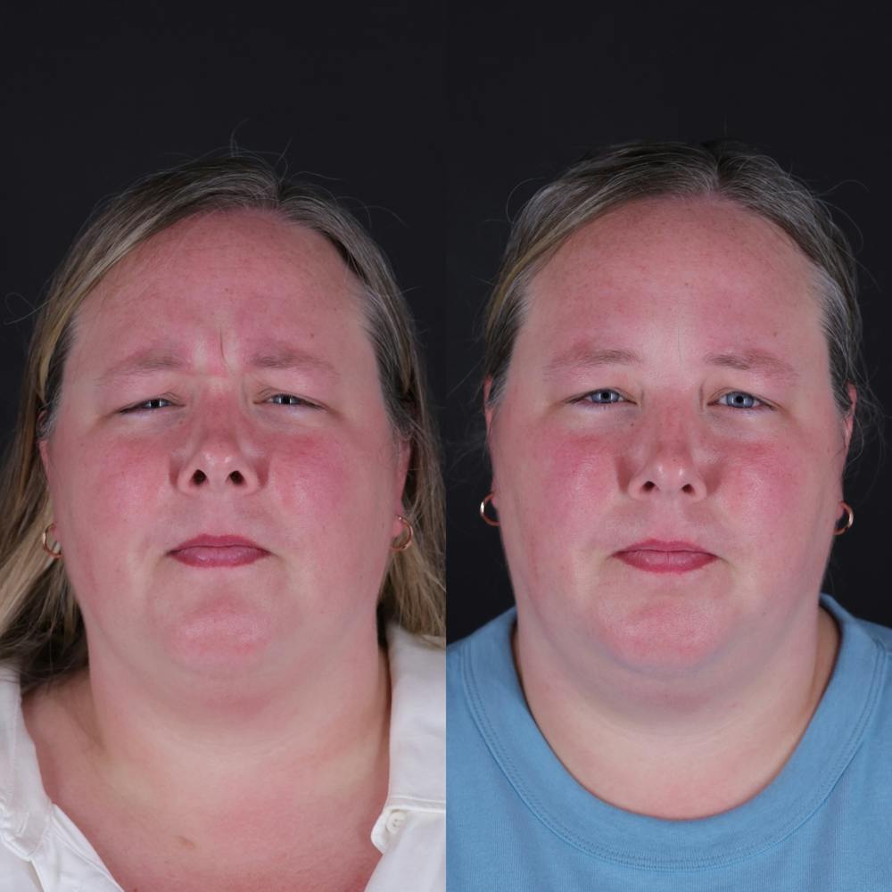 Botox Before & After Gallery - Patient 329948 - Image 1