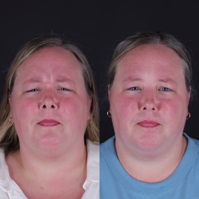 Botox Before & After Gallery - Patient 329948 - Image 1