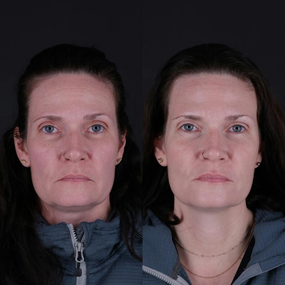 Botox Before & After Gallery - Patient 144510 - Image 2