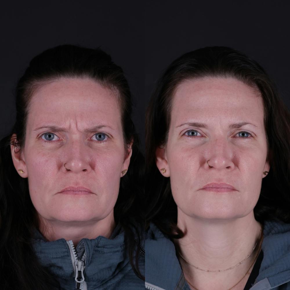 Botox Before & After Gallery - Patient 144510 - Image 3