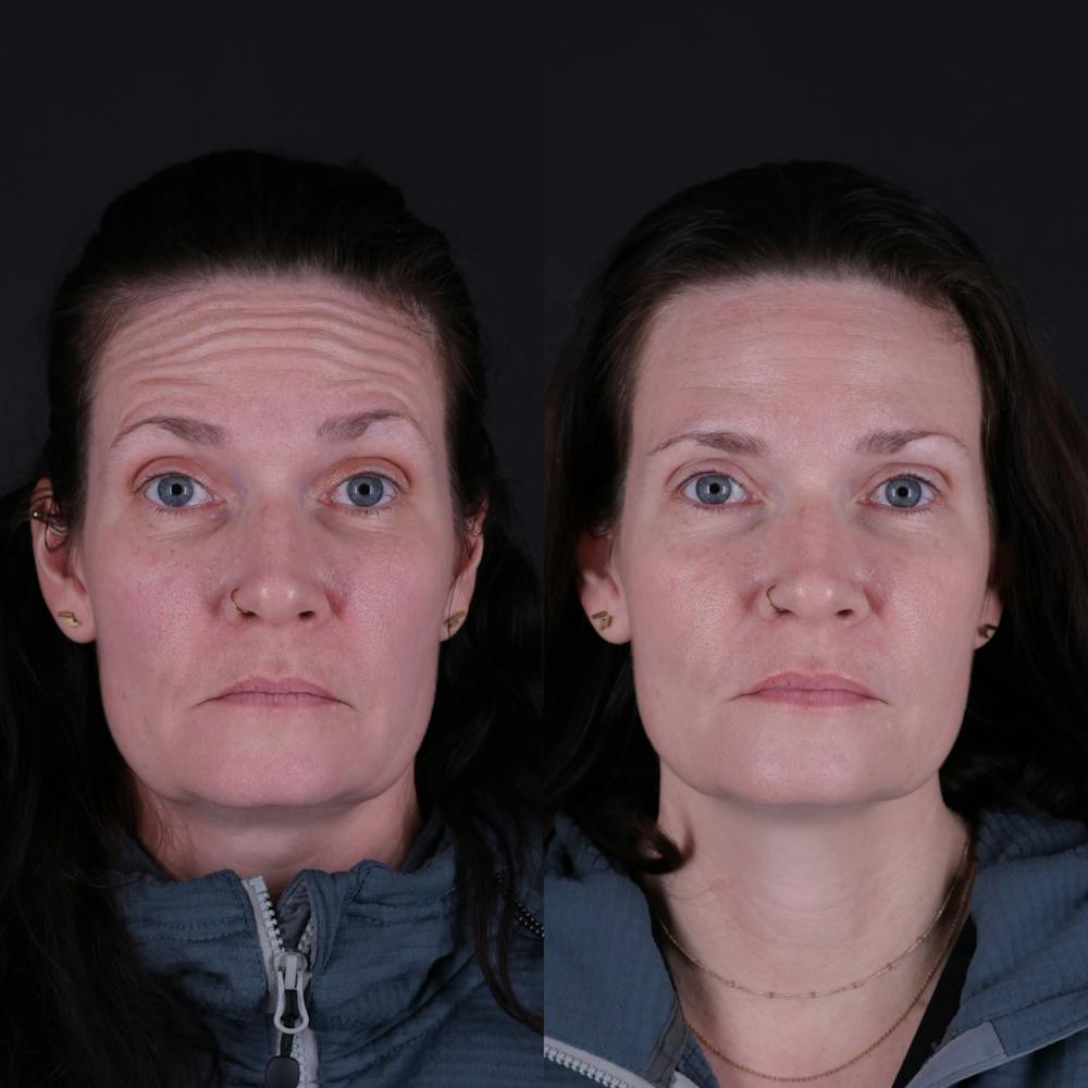 Botox Before & After Gallery - Patient 144510 - Image 1