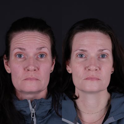 Botox Before & After Gallery - Patient 144510 - Image 1