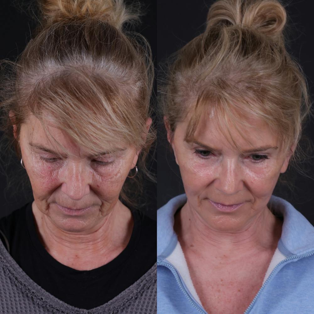 Face & Neck Lift Before & After Gallery - Patient 391950 - Image 6