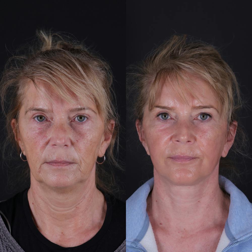 Face & Neck Lift Before & After Gallery - Patient 391950 - Image 4