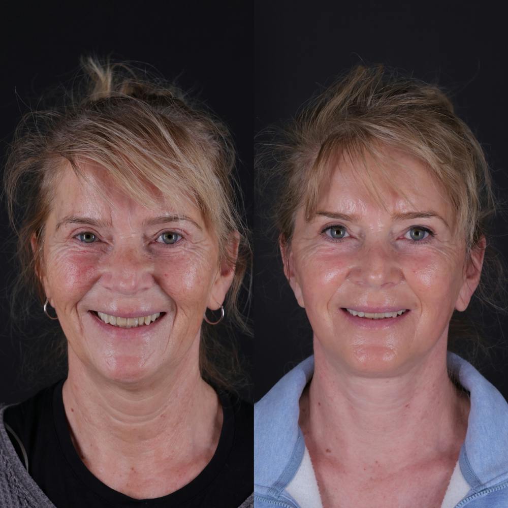 Face & Neck Lift Before & After Gallery - Patient 391950 - Image 5