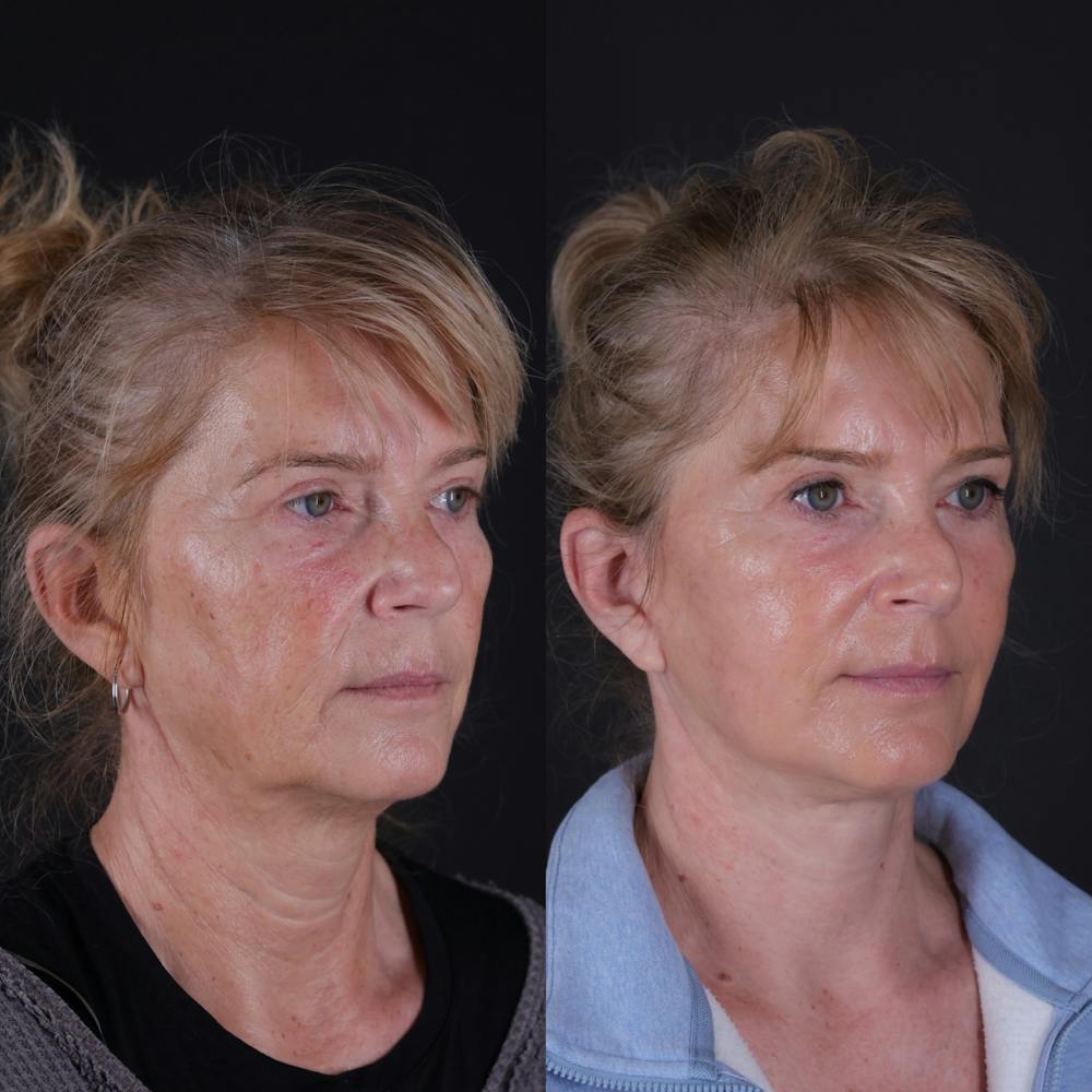 Face & Neck Lift Before & After Gallery - Patient 391950 - Image 8
