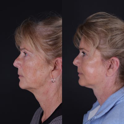 Face & Neck Lift Before & After Gallery - Patient 391950 - Image 2
