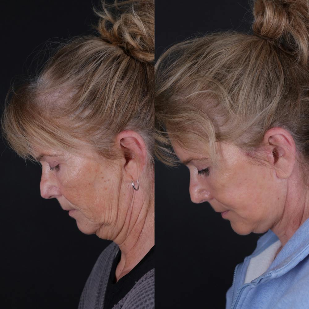 Face & Neck Lift Before & After Gallery - Patient 391950 - Image 3