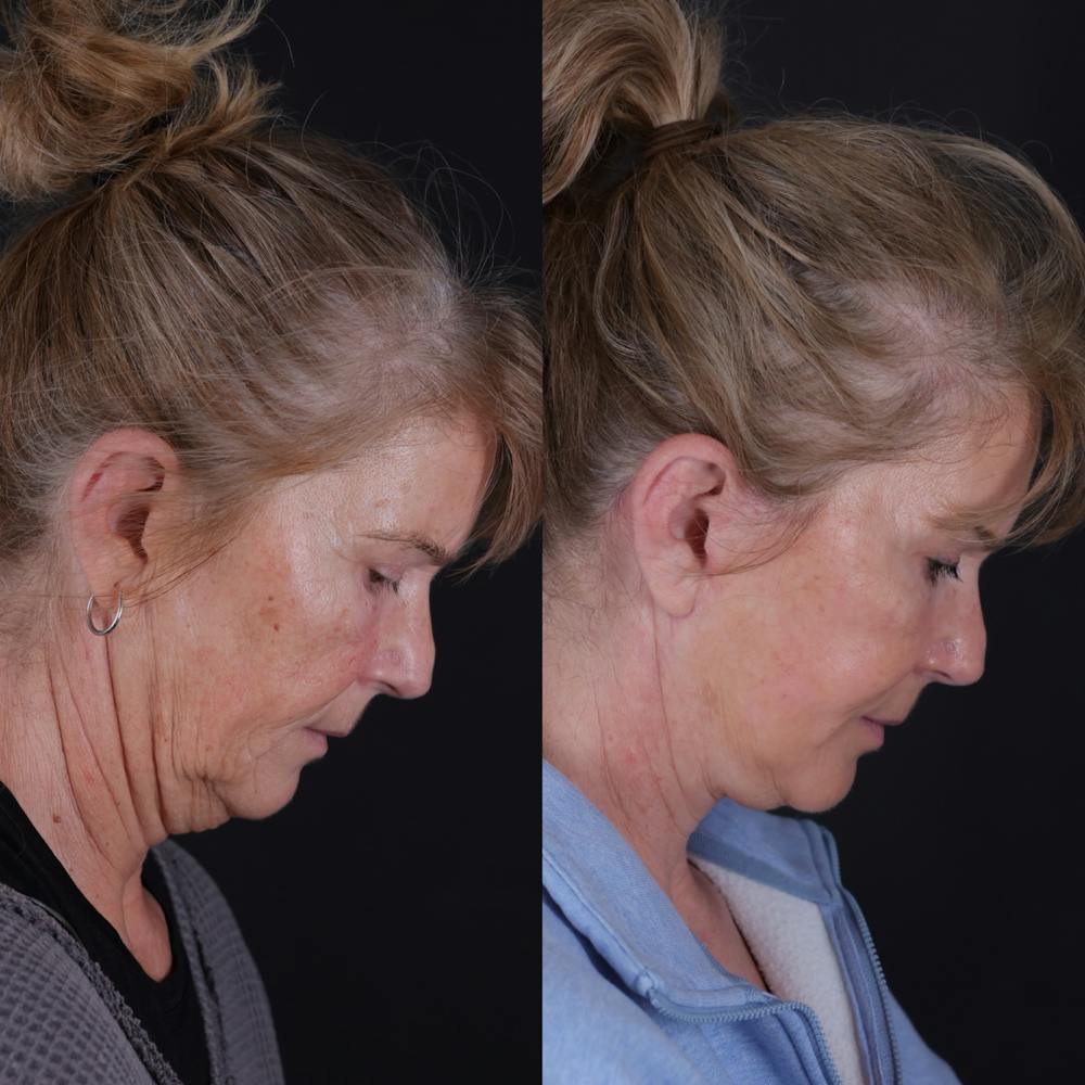 Face & Neck Lift Before & After Gallery - Patient 391950 - Image 7