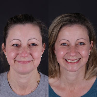 Face & Neck Lift Before & After Gallery - Patient 374021 - Image 6