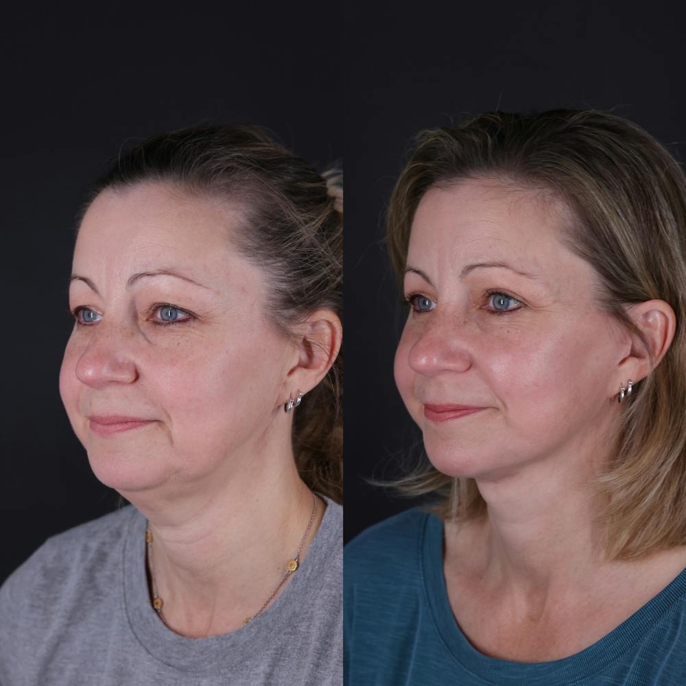 Face & Neck Lift Before & After Gallery - Patient 374021 - Image 1