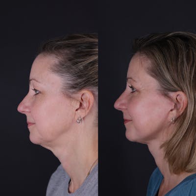 Face & Neck Lift Before & After Gallery - Patient 374021 - Image 2