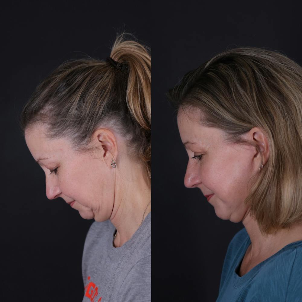 Face & Neck Lift Before & After Gallery - Patient 374021 - Image 3
