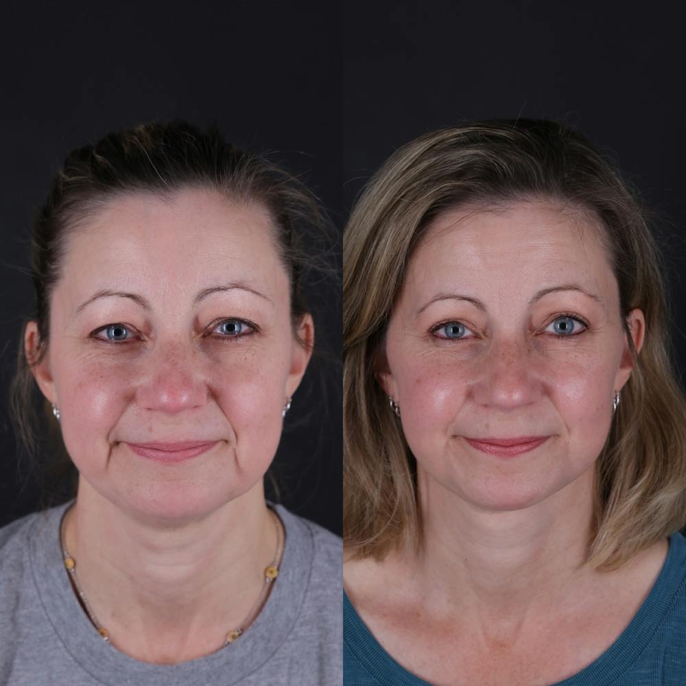 Face & Neck Lift Before & After Gallery - Patient 374021 - Image 5