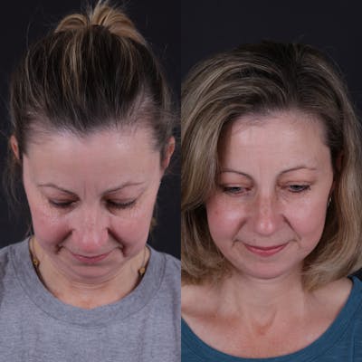 Face & Neck Lift Before & After Gallery - Patient 374021 - Image 4