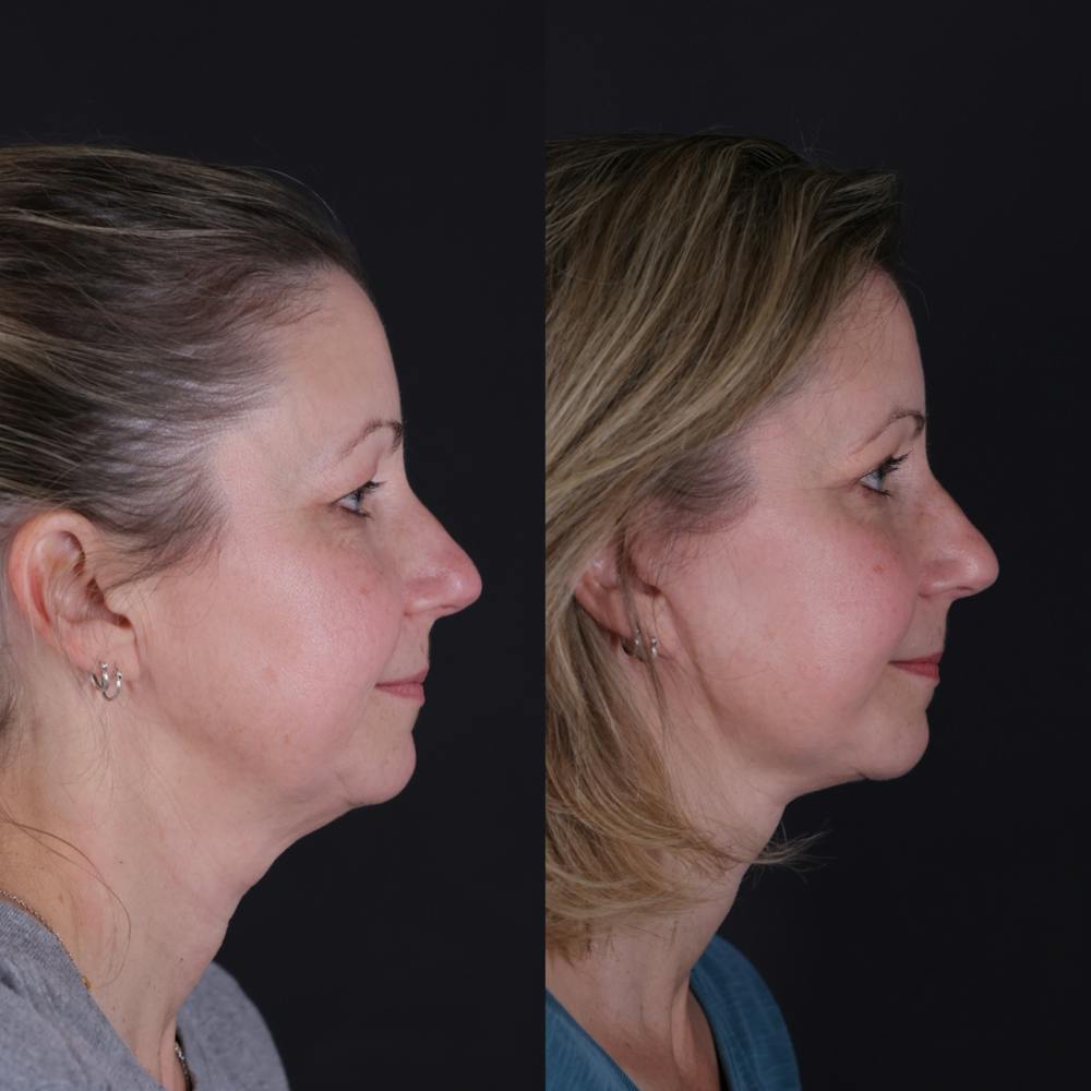 Face & Neck Lift Before & After Gallery - Patient 374021 - Image 8
